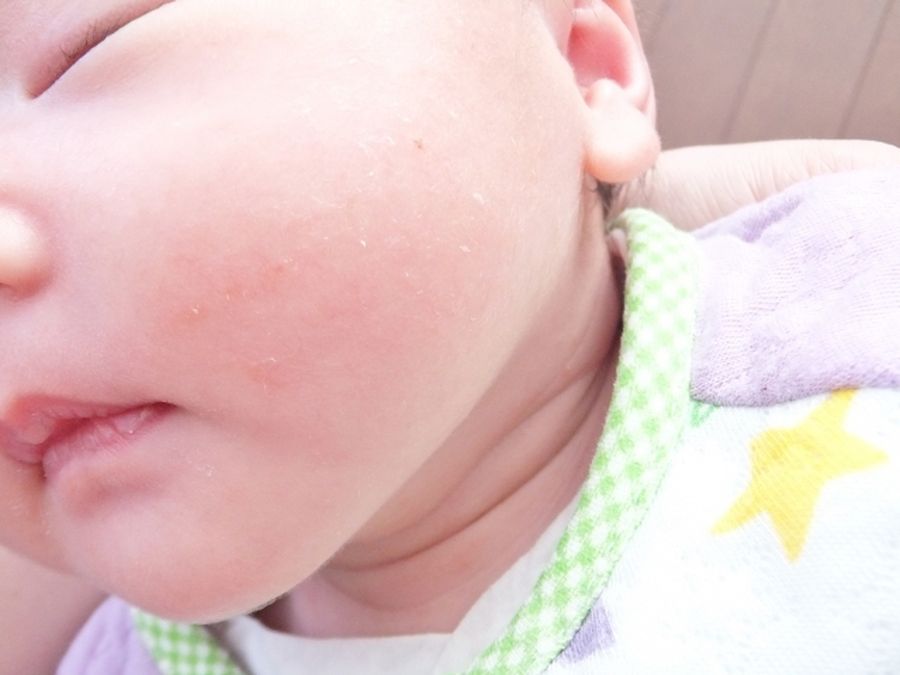 アレルギーはお肌にも 季節の変わり目は要注意 アレルギー潜在度チェック ヴァヴァイラ